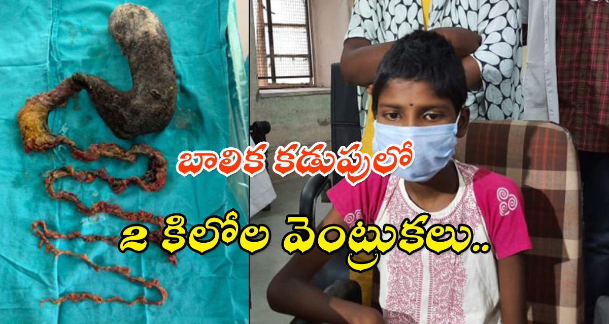 2 KG Hairs in girl stomach